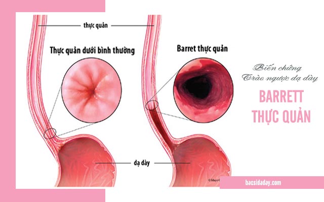 Barrett thực quản