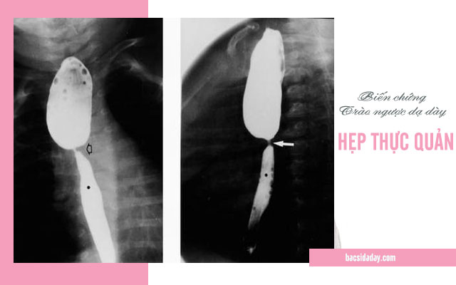 trào ngược dạ dày gây hẹp thực quản