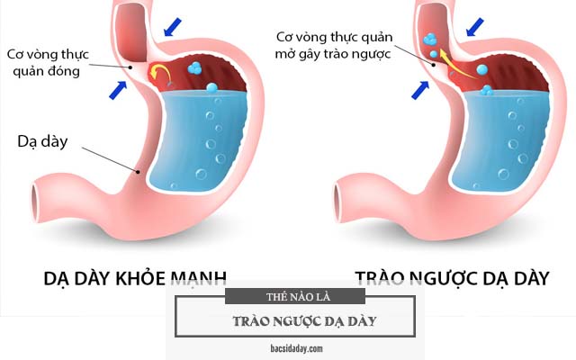 trào ngược dạ dày uống thuốc gì