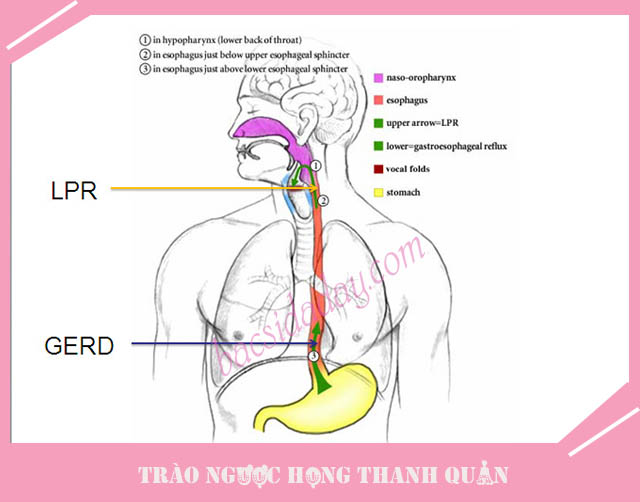 bệnh trào ngược họng thanh quản