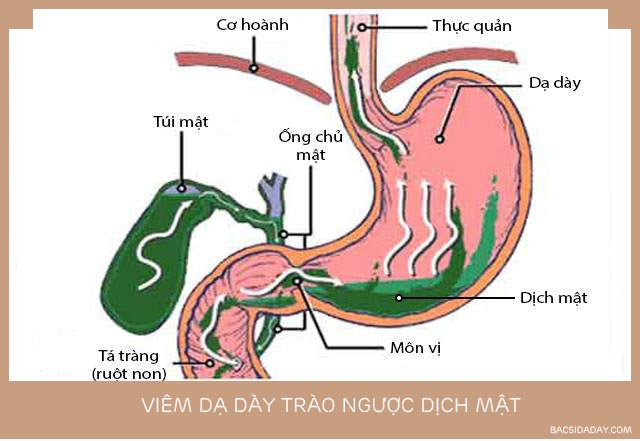 viêm dạ dày trào ngược dịch mật 