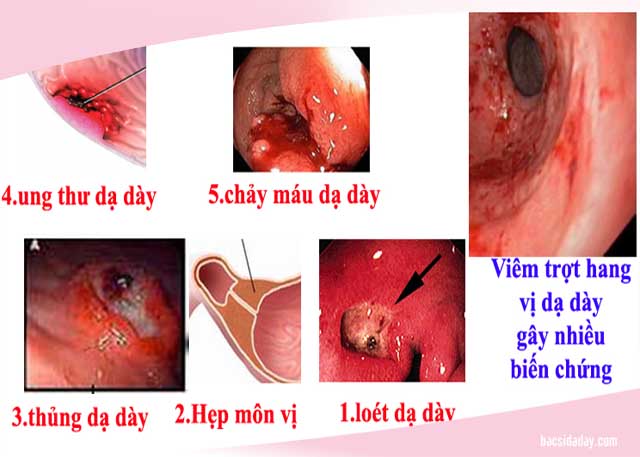 Viêm trợt hang vị dạ dày