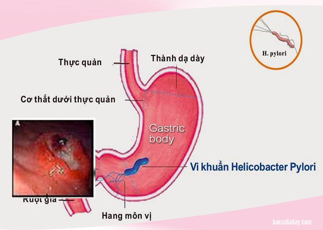 viêm trợt hang vị dạ dày có nguy hiểm không