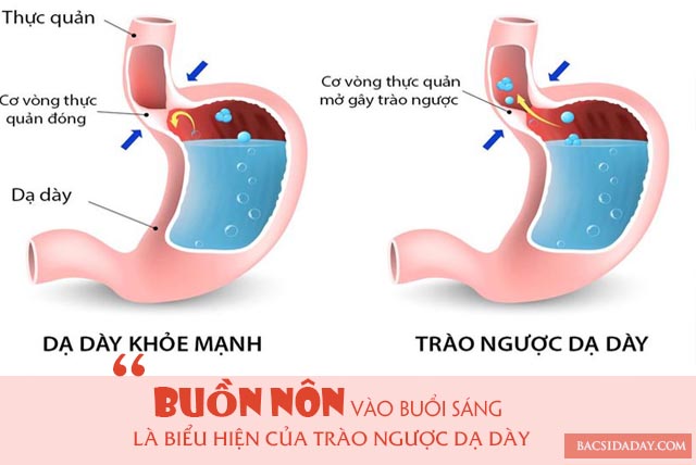 buồn nôn vào buổi sáng là bệnh gì