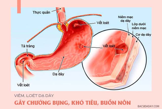 chữa bệnh đầy hơi khó tiêu và buồn nôn