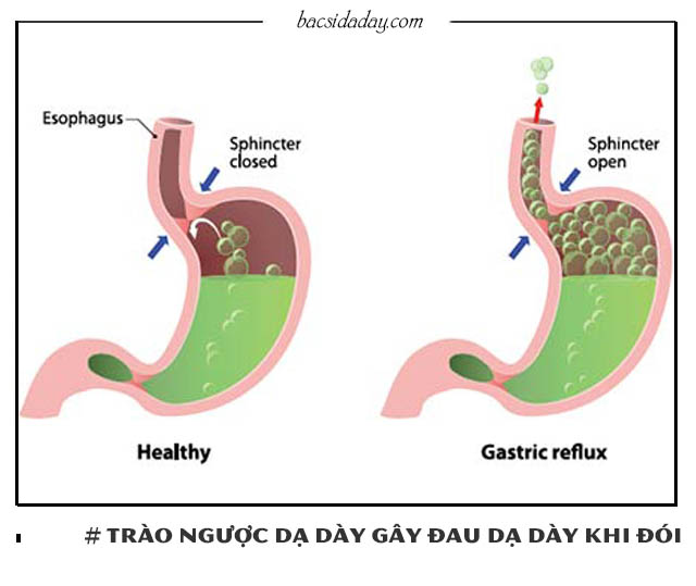 nguyên nhân đau dạ dày khi đói