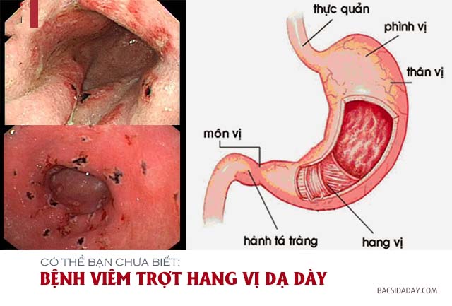 viêm trợt hang vị dạ dày