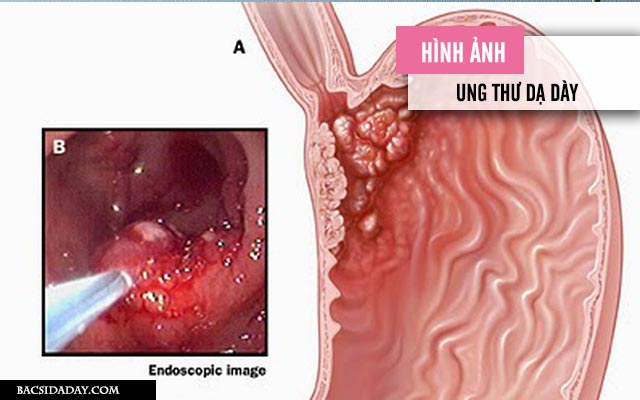 dấu hiệu nhận biết ung thư dạ dày