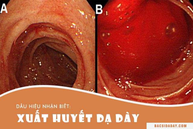 sơ cứu xuất huyết dạ dày