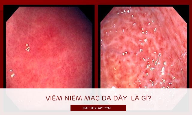 viêm niêm mạc dạ dày