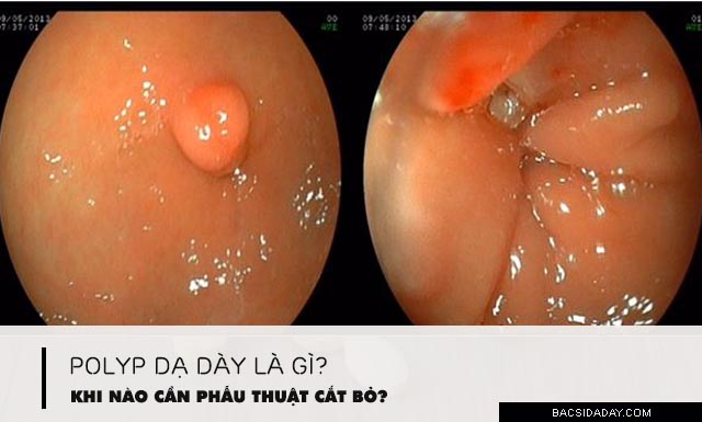 phẫu thuật polyp dạ dày