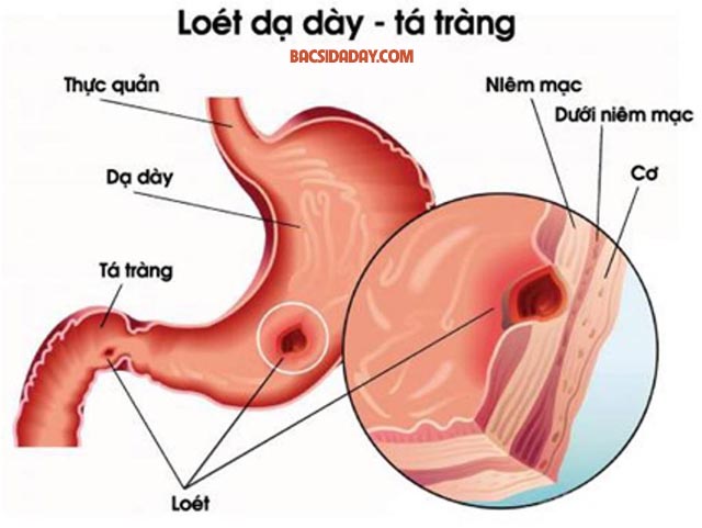 viêm loét dạ dày hành tá tràng