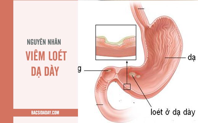 viêm loét dạ dày có lây không