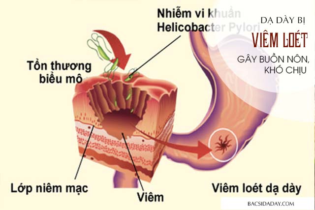 buồn nôn khó chịu sau khi ăn