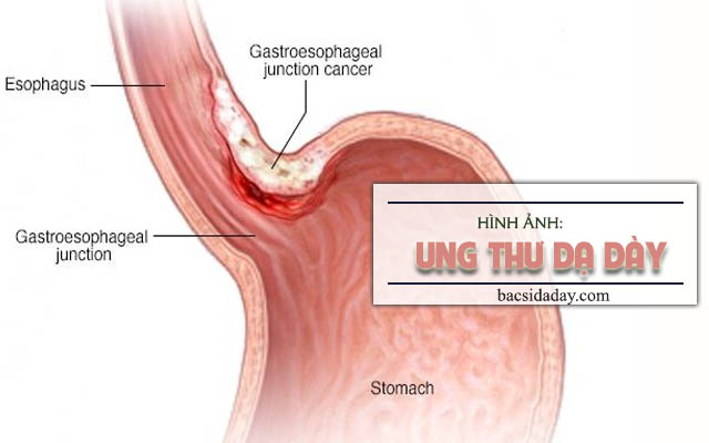 các giai đoạn của bệnh ung thư dạ dày