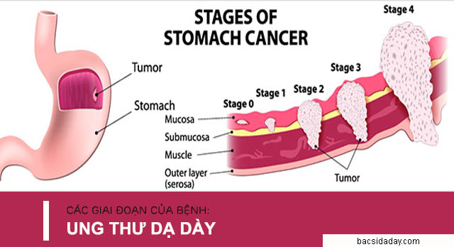 các giai đoạn phát triển của bệnh ung thư dạ dày