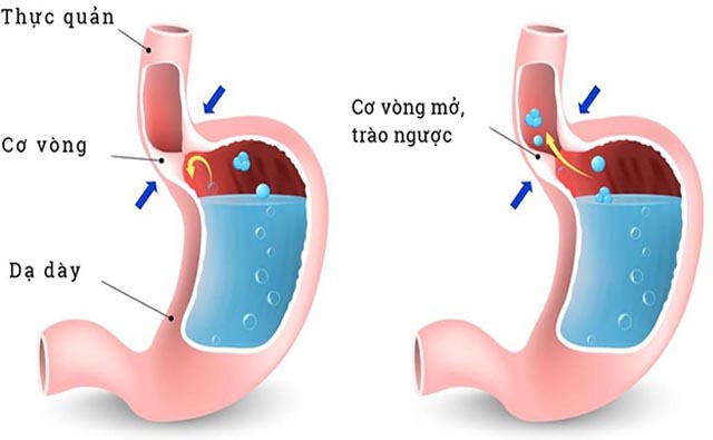 nguyên nhân gây ợ nóng