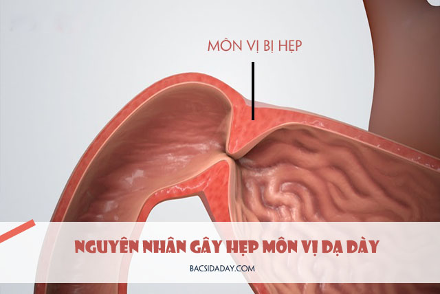 nguyên nhân gây hẹp môn vị dạ dày