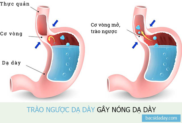 nóng dạ dày là bệnh gì