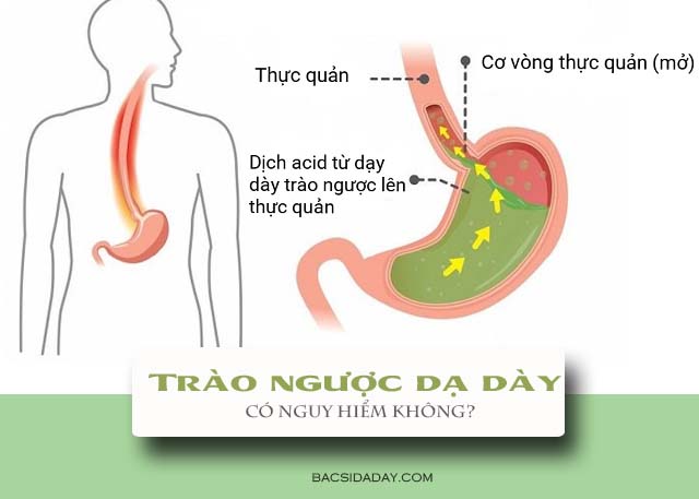 Trào ngược dạ dày thực quản có nguy hiểm không