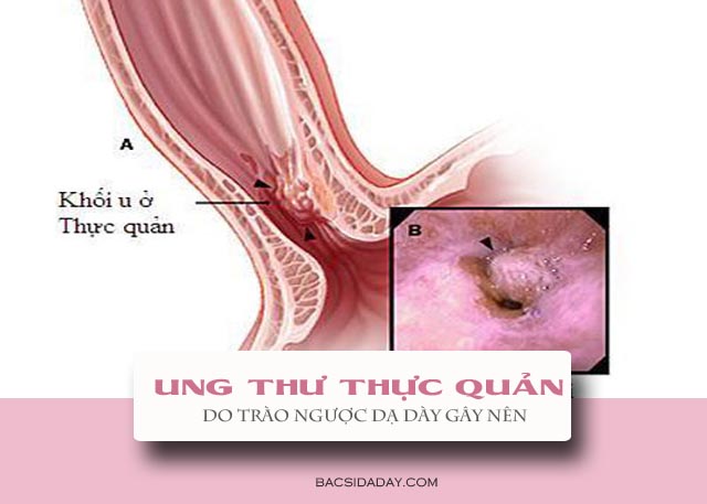 trào ngược dạ dày có nguy hiểm không