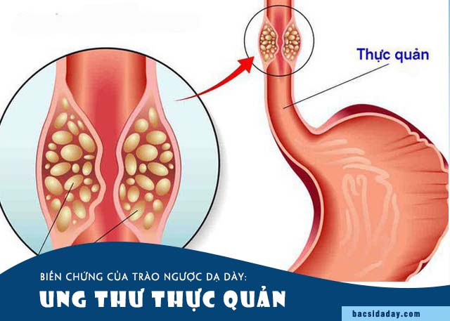 ung thư thực quản