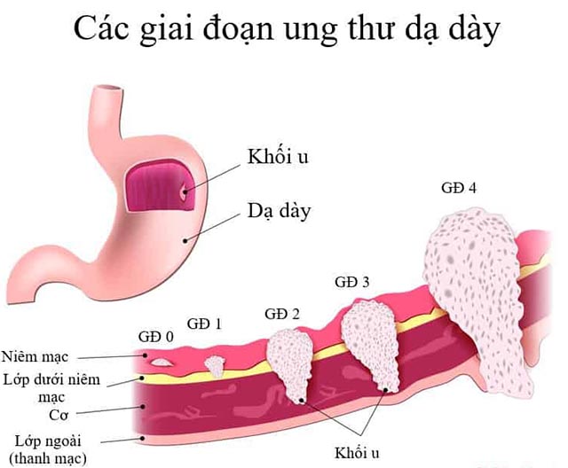 các giai đoạn phát triển bệnh ung thư dạ dày