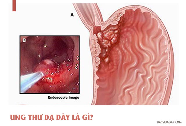 Bệnh ung thư dạ dày có di truyền không