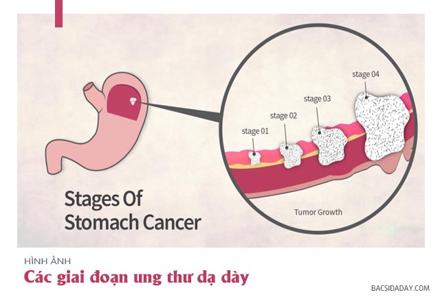 ung thư dạ dày sống được bao nhiêu năm