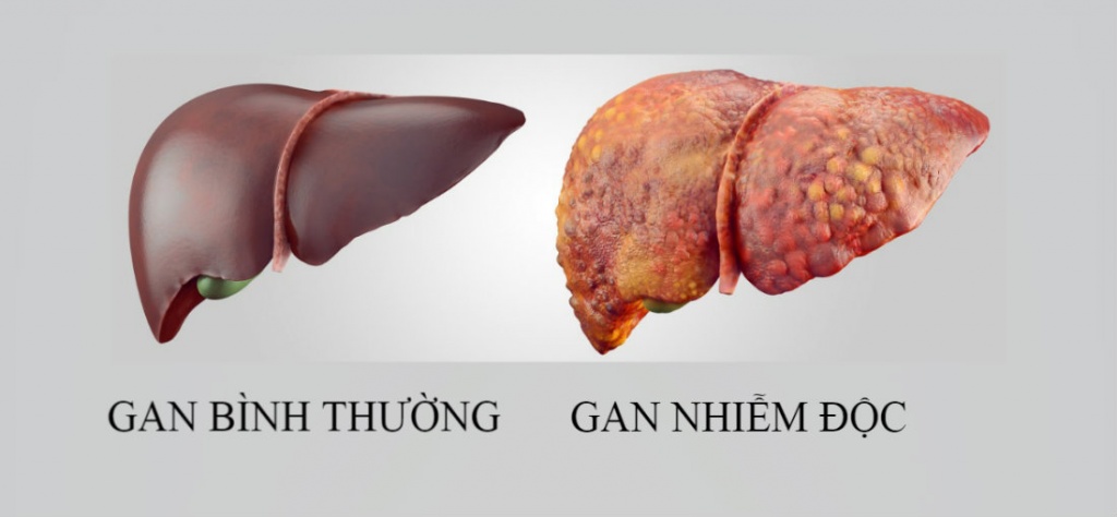 Rượu, bia chính là thủ phạm số 1 khiến gan bị nhiễm độc